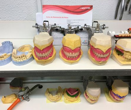 Protésico Dental Francisco Javier Socarrás fabricación de implantes y prótesis dentales 4