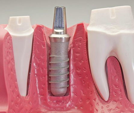 Protésico Dental Francisco Javier Socarrás fabricación de implantes y prótesis dentales 3
